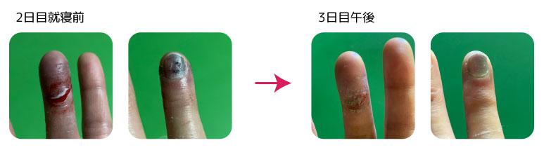 クイックヒール ビフォーアフター
